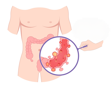 diverticolite diverticolosi malattia diverticolare